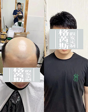 男生增發(fā)可以試試物理增發(fā)織發(fā)補(bǔ)發(fā)產(chǎn)品，這種可以快速增加發(fā)量，達(dá)到密發(fā)效果