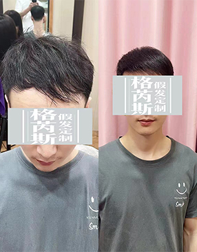 定制補(bǔ)發(fā)及以后日常大力是必不可少的，良好的使用習(xí)慣讓假發(fā)更好看