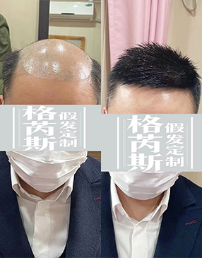 到店測(cè)量頭型，根據(jù)脫發(fā)面積大小進(jìn)行測(cè)量，獲取補(bǔ)發(fā)重要數(shù)據(jù)