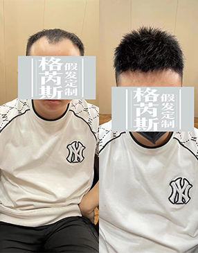 測(cè)量后，與客戶(hù)溝通需要定制的樣式造型和發(fā)長(zhǎng)制定，確定補(bǔ)發(fā)方案